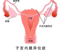 哪些女性易患子宫内膜异位症？