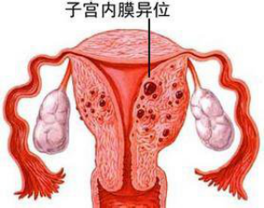 子宫内膜异位症的症状有哪些？
