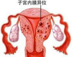 子宫内膜异位的并发症有哪些？