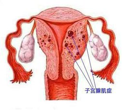 子宫腺肌症能怀孕吗？