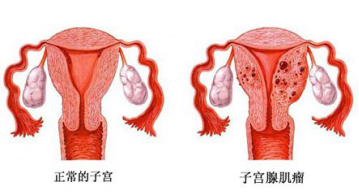 如何预防子宫腺肌症？